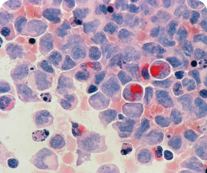 Cancer as a pre-exisiting condition
